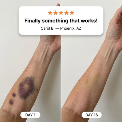 💥100K+ SOLD💕- LUMIVO® Bruise Repair & Skin-Strengthening Cream